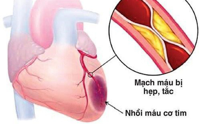 Bệnh Thiếu máu cơ tim cục bộ: Nguyên nhân, biến chứng và cách điều trị